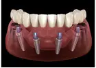 All-on-4 Dental Implants in Tijuana, Mexico – Affordable, Life-Changing Results!
