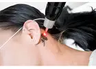 Envy Aesthetics Offer Laser Tattoo Removal With Precision And Care