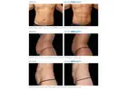 CoolSculpting Treatment  – Freeze Stubborn Fat at ISAAC Luxe