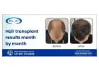 Hair Transplant Results Month By Month - FuseHair