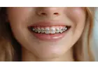 Affordable Braces Singapore – Achieve Your Perfect Smile