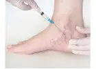 Understanding Varicose Veins Treatment Cost in Pune