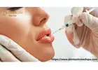 Enhance Natural Beauty with Best Lip Fillers Riverside