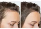 Scalp Micropigmentation: Semi-Permanent Solution to Restore Hair Density