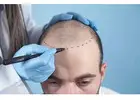 Hair Transplant in Islamabad