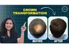 Top-Tier Results: The Best Hair Transplant Clinic in Ahmedabad