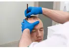 Dr Ditta Hair Transplants Creates Natural Results with Hair Implants in Manchester