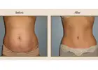 Best Liposuction Results Guaranteed in Islamabad