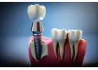 Dental implants in Islamabad
