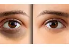 Best Dark Circles Treatment in Islamabad