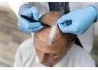 Dr Ditta Hair Transplants – DHI Hair Transplant Services in Manchester