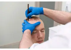 Dr Ditta Hair Transplants – Hair Implants at Manchester for Natural Restoration
