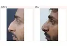 Nose surgery cost in Delhi - Dr Rajat Gupta