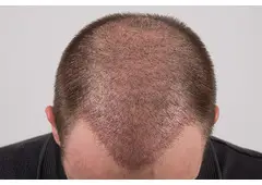 FUT Hair Transplant in Islamabad