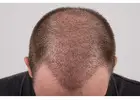 FUT Hair Transplant in Islamabad