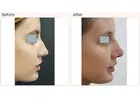 Rhinoplasty Surgery Before and After: Real Results and What to Expect