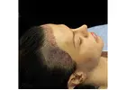 FUE Hair Transplant in Islamabad