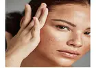 Melasma Treatment in Islamabad