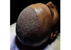 FUE Hair Transplant in Islamabad