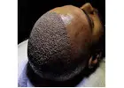 FUE Hair Transplant in Islamabad