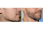 Beard Hair Transplant in Islamabad