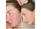 Amálie Aesthetics - Dermaplaning at Nashville TN for Instant Glass-Skin Glow