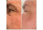 Try Fibroblast Skin Tightening Treatment by Envy Aesthetics