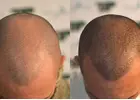 Scalp Micropigmentation in Islamabad