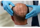 Hair Transplant in Islamabad
