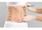 Liposuction in Islamabad