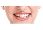 Professional Teeth Whitening Philly Services Helping Patients Achieve Brighter Confident Smiles