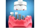 Dental Implant Therapy: A Long-Lasting Solution for Missing Teeth