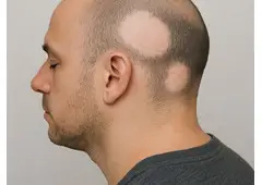 Effective Herbal Alopecia Areata Treatment in Noida with Expert Care