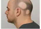 Effective Herbal Alopecia Areata Treatment in Noida with Expert Care