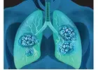 Lung Cancer Craigieburn