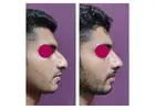Best Clinic for Rhinoplasty in Islamabad
