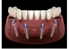 All-on-4 Dental Implants in Tijuana, Mexico – Affordable, Life-Changing Results!