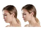 Jaw Surgery in Islamabad for Proper Jaw Alignment