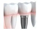 Best Dental Implants Melbourne by Experienced Dentists