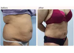 Liposuction Surgery in Delhi - Dr Rajat Gupta