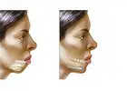 Chin augmentation surgery cost in Delhi - Dr Rajat Gupta