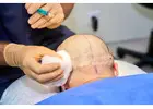 Best Hair Transplant Doctor in Delhi