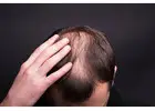 QR678 Hair Treatment in Pune for Hair Loss and Regrowth Support