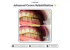 Advanced Crown Rehabilitation in Gurgaon | Dr. Anukriti Gupta