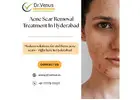 Acne Scar Removal Treatment In Hyderabad | Dr. Venus