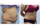 Latest Liposuction Technologies Used by Leading Surgeons
