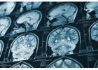Fighting for Brain Injury Victims in Rancho Cucamonga Legal Help Available