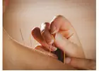 Top Fertility Acupuncture NYC