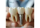 Best High-Quality Dental Implant Equipment in Peru