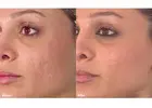 Erbium Laser Skin Resurfacing Clermont
